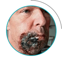 Грибок Протект